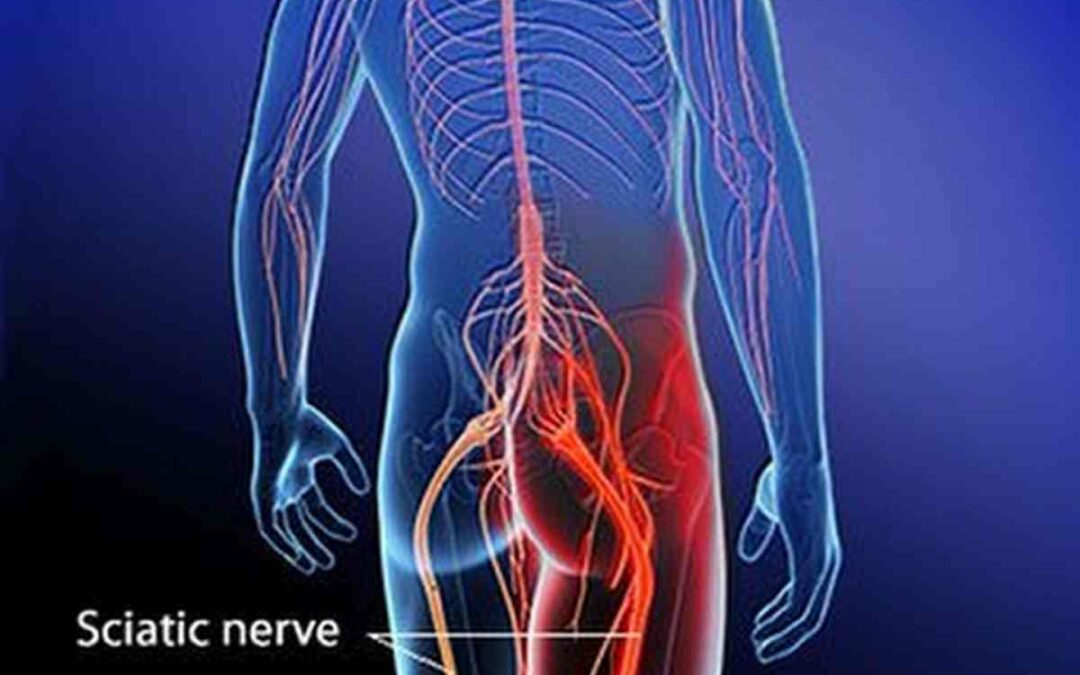 La sciatalgia detta anche “sciatica” (Terapia Radicale del Dolore)