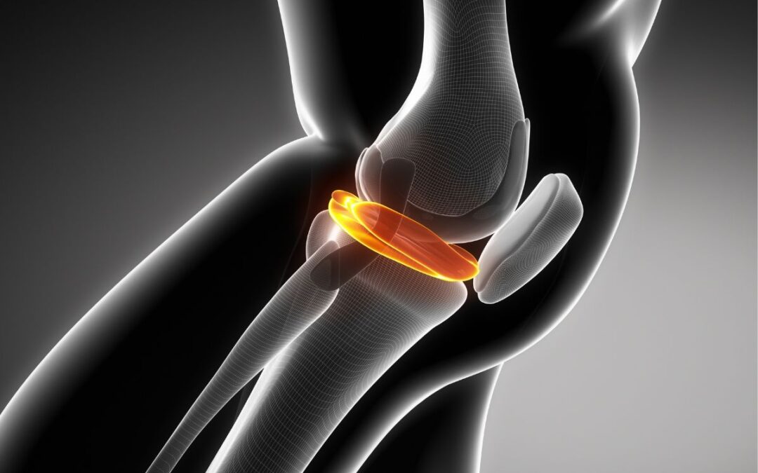 La lesione del menisco del ginocchio