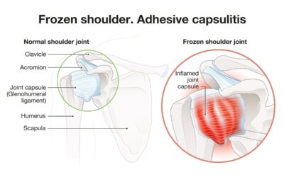La “Frozen Shoulder” o “Spalla Congelata”