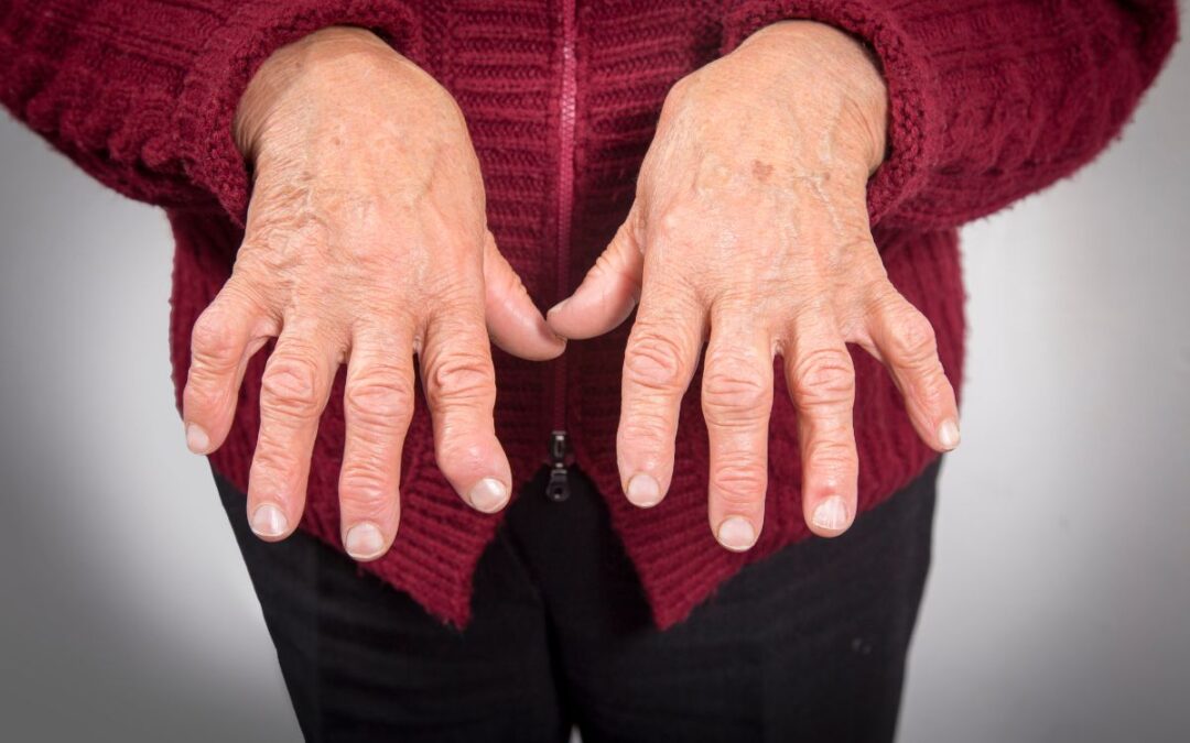 artrite o artrosi