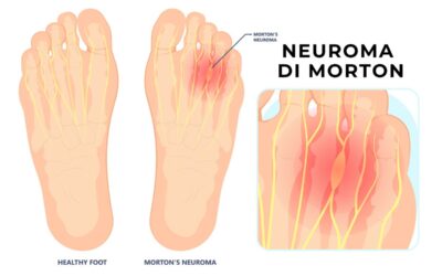 Il Neuroma di Morton – Diagnosi e Terapia Diretta Locale ambulatoriale