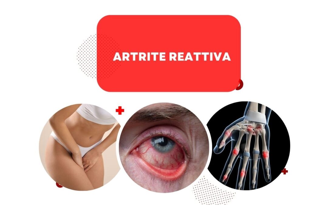 artrite reattiva